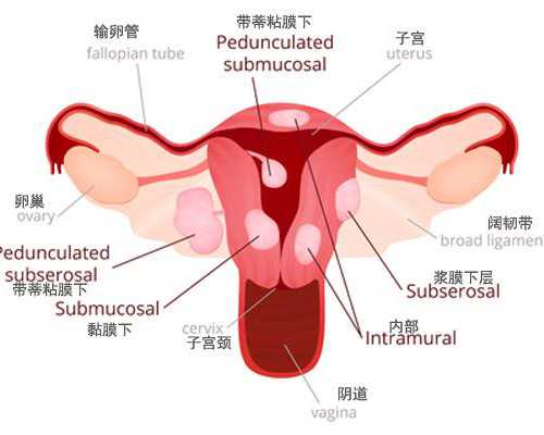 供卵借卵医院~先天性幼稚子宫分为多种类型？先天性幼稚子宫有治吗？